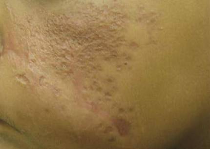 What Is Your Diagnosis? Fixed Cutaneous Sporotrichosis | MDedge